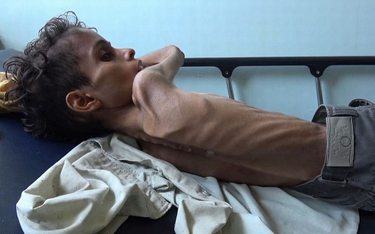 Save the Children: 85 tys. dzieci w Jemenie umarło z głodu