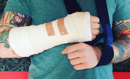 Ed Sheeran złamał rękę