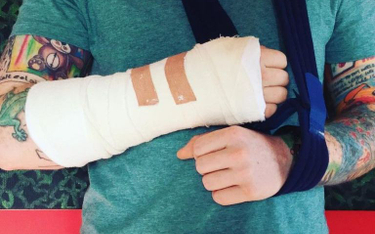 Ed Sheeran złamał rękę