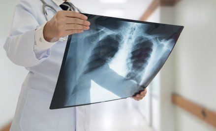 Lekarze bez Granic chcą skończyć z gruźlicą na świecie