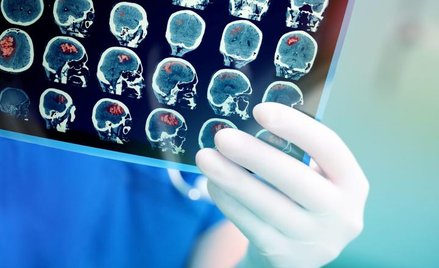 Przemijające objawy przypominające udar mogą być zapowiedzią poważnego ataku choroby