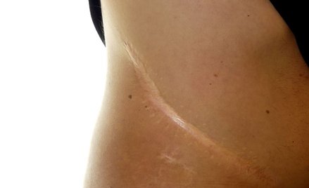 Blizna po transplantacji nerki