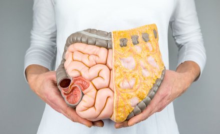Rak jelita grubego: Otyłe kobiety narażone dwa razy bardziej
