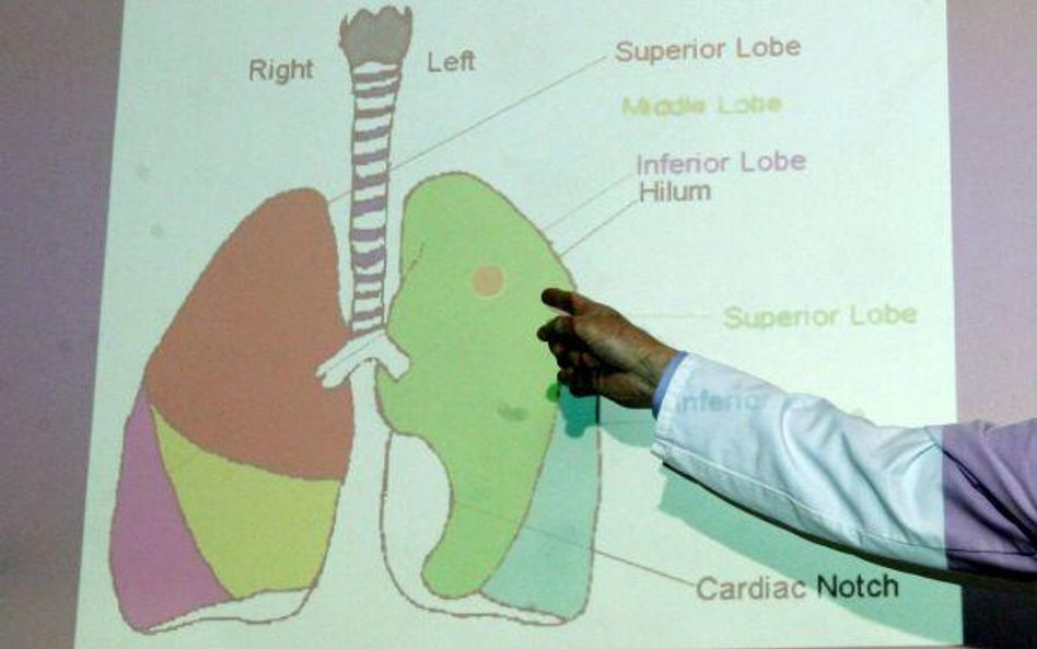 Rak płuc wykrywany na podstawie analizy próbek oddechu