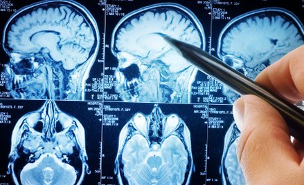 Jak COVID-19 niszczy mózg