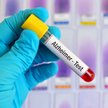 Niestety nie ma jeszcze testów, które pozwalają identyfikować osoby narażone na rozwój alzheimera pr