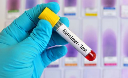 Niestety nie ma jeszcze testów, które pozwalają identyfikować osoby narażone na rozwój alzheimera pr