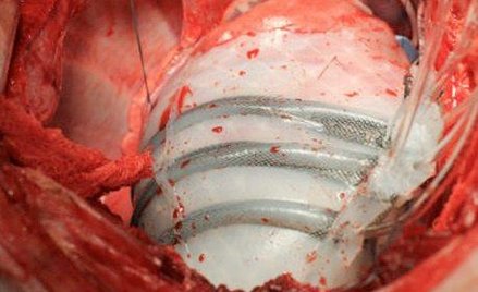 Opaska jest napełniana powietrzem i naśladuje prace prawdziwych mięśni