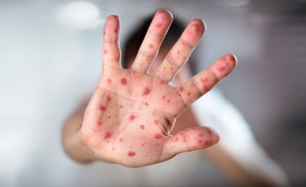 Władze Georgii: Podejrzewasz u siebie odrę? Dzwoń, nie idź do lekarza