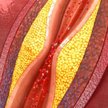 Nowy lek skutecznie walczy z nadmiarem cholesterolu.