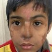 Arun Patel nosił swój nowy nos na czole przez trzy miesiące