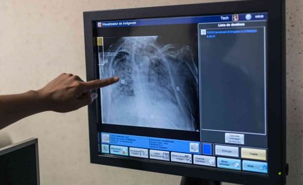 Badacze: Jest kolejny steryd, który pomaga w terapii COVID-19