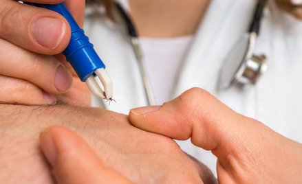 Kleszcza najlepiej wyciągać specjalnymi szczypczykami czy kleszczołapkami - możemy zrobić to również