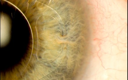 Fot: Mark Bartley. Zdjęcie pokazuje sztuczną soczewkę wewnątrzgałkową (IOL) w oku 70-letniego mężczy