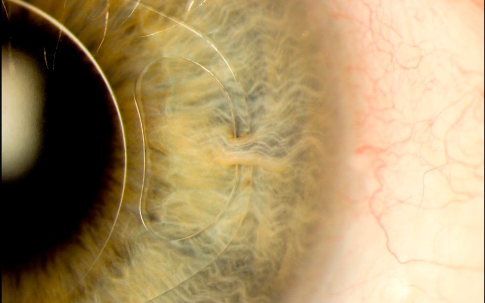 Fot: Mark Bartley. Zdjęcie pokazuje sztuczną soczewkę wewnątrzgałkową (IOL) w oku 70-letniego mężczy