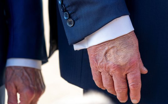 Publikowane niedawno zdjęcia pokazują, że na jednej z dłoni Trumpa widać siniaki