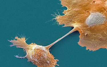 Portret zabójcy – komórka nowotworowa pod mikroskopem