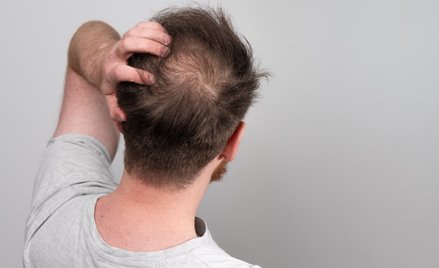 Osoby, które naturalnie mają większą aktywność receptora GLP-1R, częściej doświadczają łysienia.