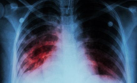 Gruźlica zmienia oblicze