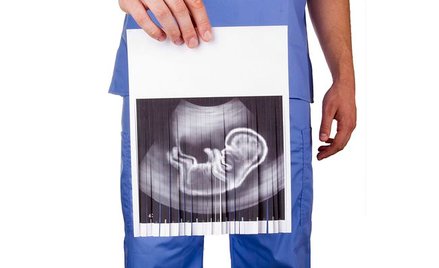 Projekt zakazujący aborcji eugenicznej z pozytywną opinią Sejmowej Komisji Sprawiedliwości i Praw Cz