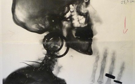 Meret Oppenheim, Szkic do zdjęcia rentgenowskiego czaszki M.O. (Entwurf für X-Ray – Röntgenaufnahme 