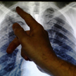 Zdjęcie rentgenowskie płuc zajętych przez turberkulozę