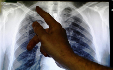 Zdjęcie rentgenowskie płuc zajętych przez turberkulozę