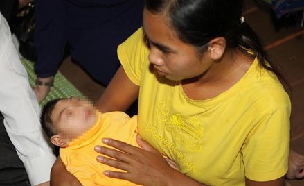 Czteromiesięczna dziewczynka z Wietnamu urodziła się z mikocefalią wywołaną wirusem Zika