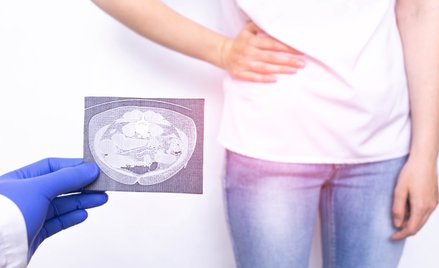 Gruczolakorak wyrostka robaczkowego to wyjątkowo trudny do zdiagnozowania typ nowotworu.