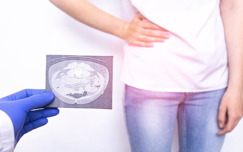 Gruczolakorak wyrostka robaczkowego to wyjątkowo trudny do zdiagnozowania typ nowotworu.