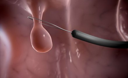 Polipy jelita grubego można usunąć podczas kolonoskopii. Aspiryna i omega-3 zmniejszają ich ilość.
