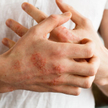 Łuszczyca jest przewlekłą, chorobą immunologiczną, która objawia się zmianami na skórze, ale ma też 