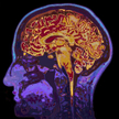 Cząsteczki ze spalin mogą zwiększać ryzyko zachorowania na chorobę Alzheimera