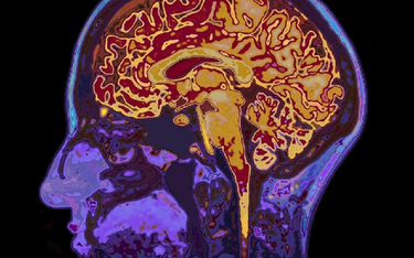 Cząsteczki ze spalin mogą zwiększać ryzyko zachorowania na chorobę Alzheimera