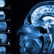 Dzięki obrazowaniu fMRI odkrywa się wiele przypadków osób, u których brakuje niemal całej tkanki móz