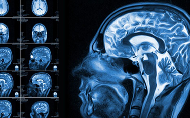 Dzięki obrazowaniu fMRI odkrywa się wiele przypadków osób, u których brakuje niemal całej tkanki móz