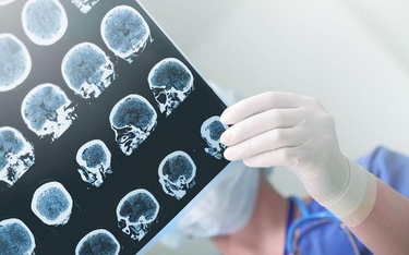 NIK krytycznie o leczeniu pacjentów z udarem mózgu