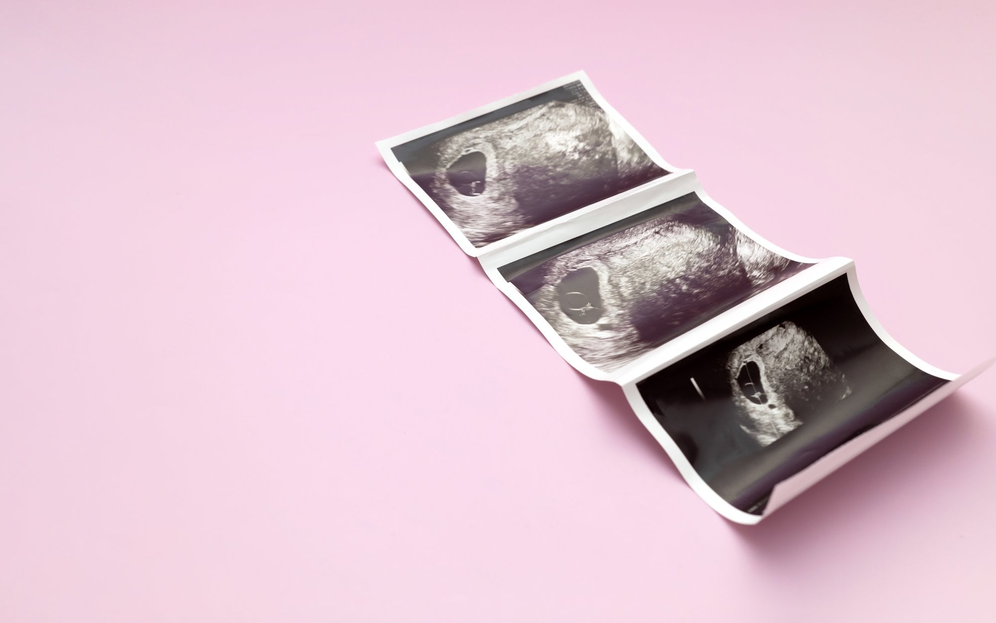 Aborcja jednego z bliźniąt bez wskazań medycznych. Pomogły polskie aktywistki
