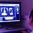 Obraz uszkodzonych płuc 13-letniej dziewczynki cierpiącej na mukowiscydozę