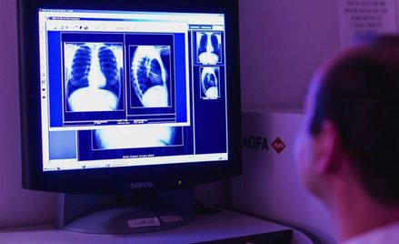 Obraz uszkodzonych płuc 13-letniej dziewczynki cierpiącej na mukowiscydozę