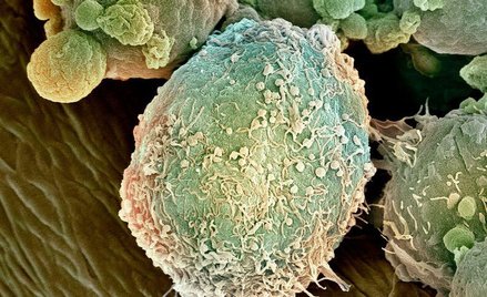 Komórka chłoniaka pod mikroskopem elektronowym