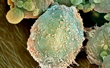 Komórka chłoniaka pod mikroskopem elektronowym