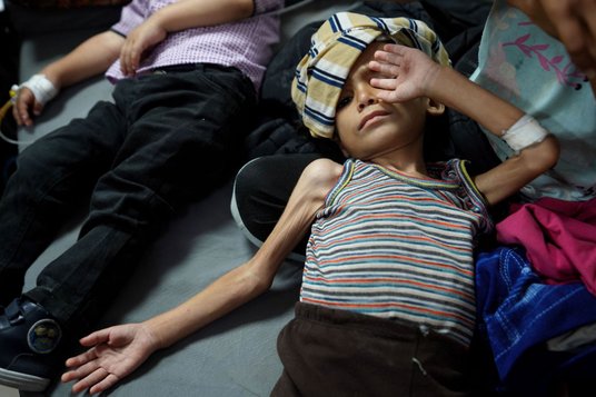 Wygłodzone palestyńskie dziecko w szpitalu Męczenników Al-Aksa w mieście Dajr al-Balah w Strefie Gaz