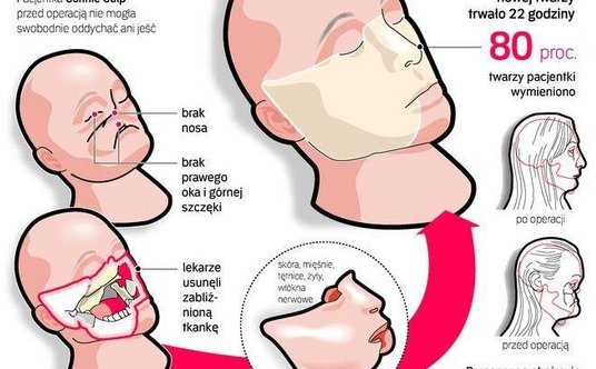 Pierwszy przeszczep twarzy, który w 2008 r. przeprowadziła profesor Maria Siemionow