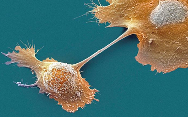 Komórki raka trzustki. Nieregularny, postrzępiony kształt charakterystyczny jest dla komórek nowotwo