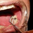 Dentysta ujawniający stan uzębienia pacjenta narusza tajemnicę lekarską