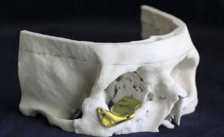 Gdańsk: Nowatorski zabieg rekonstrukcji oczodołu