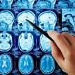 10 groźnych chorób mózgu. Są częstsze, niż myślimy