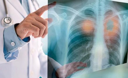 Podstawowym badaniem, od którego zaczyna się proces diagnostyczny, jest RTG klatki piersiowej