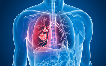 Płuca zaczynają boleć, gdy nowotwór jest już zaawansowany, a leczenie nie zawsze skuteczne